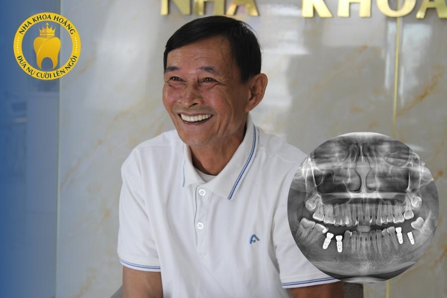 Địa chỉ cấy ghép Implant uy tín và chất lượng tại Đồng Nai