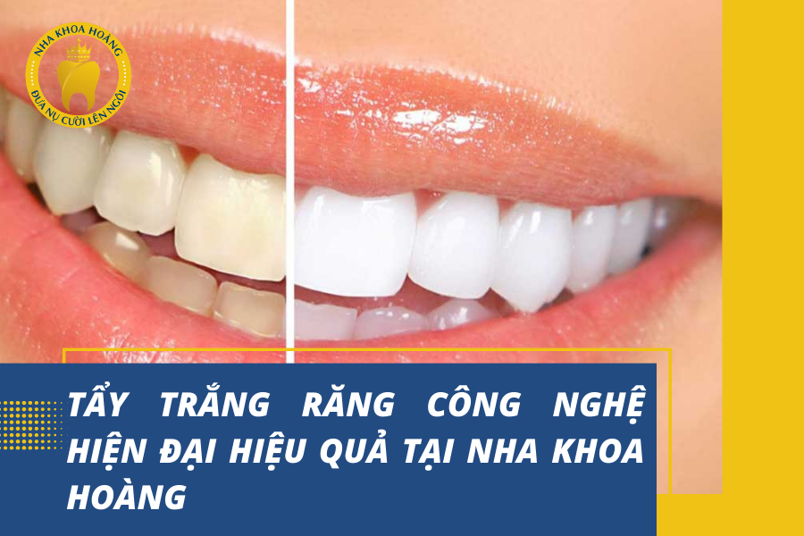 Tẩy trắng răng công nghệ hiện đại hiệu quả tại Nha khoa Hoàng