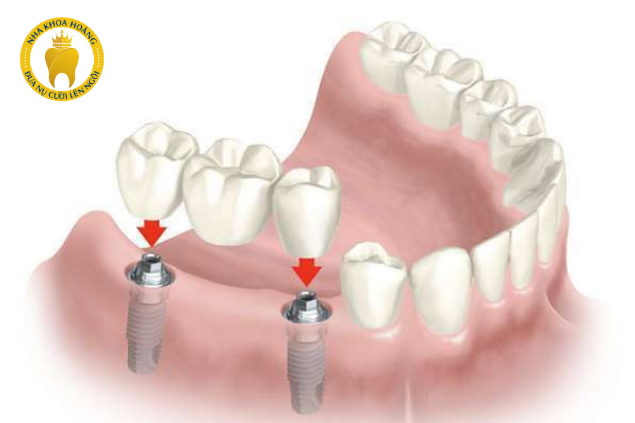 Cầu răng sứ trên Implant được chỉ định cho trường hợp khách hàng bị mất 3 răng liên tiếp