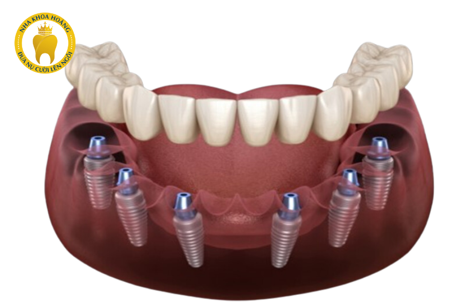Implant toàn hàm đảm bảo tính thẩm mỹ và chức năng ăn nhai như răng thật