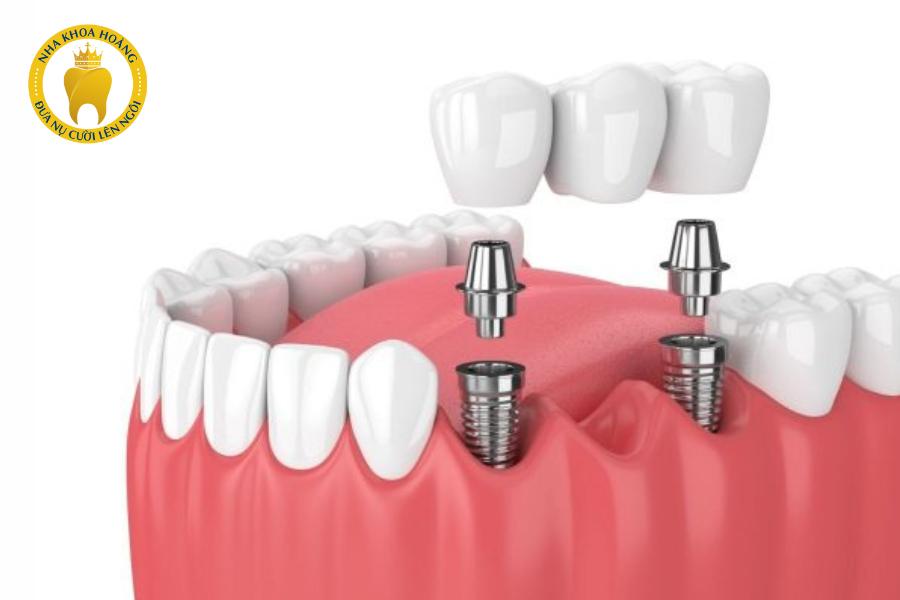 Cấy ghép Implant là giải pháp hoàn hảo cho người mất răng