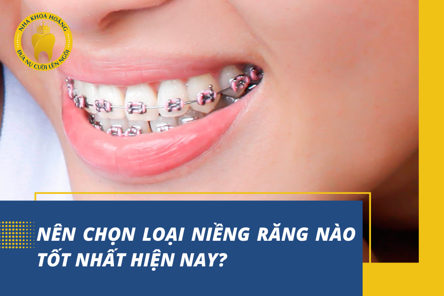Nên chọn loại niềng răng nào tốt nhất hiện nay?