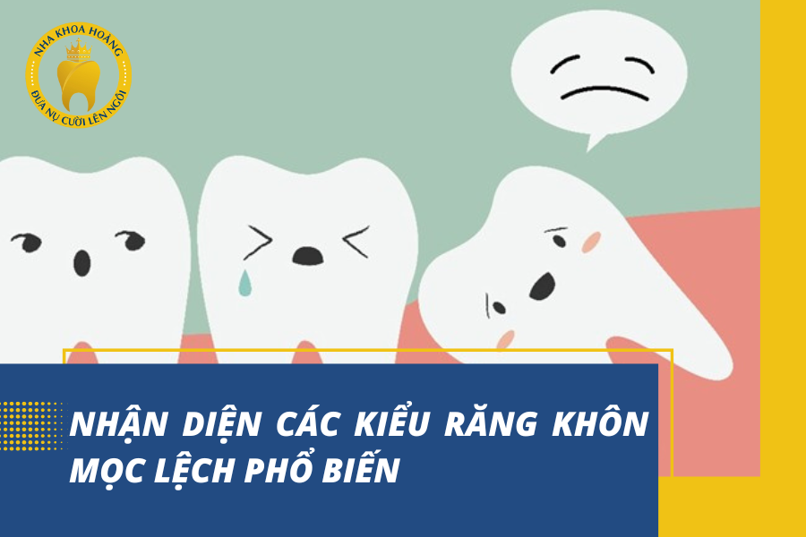 Nhận diện các kiểu răng khôn mọc lệch phổ biến