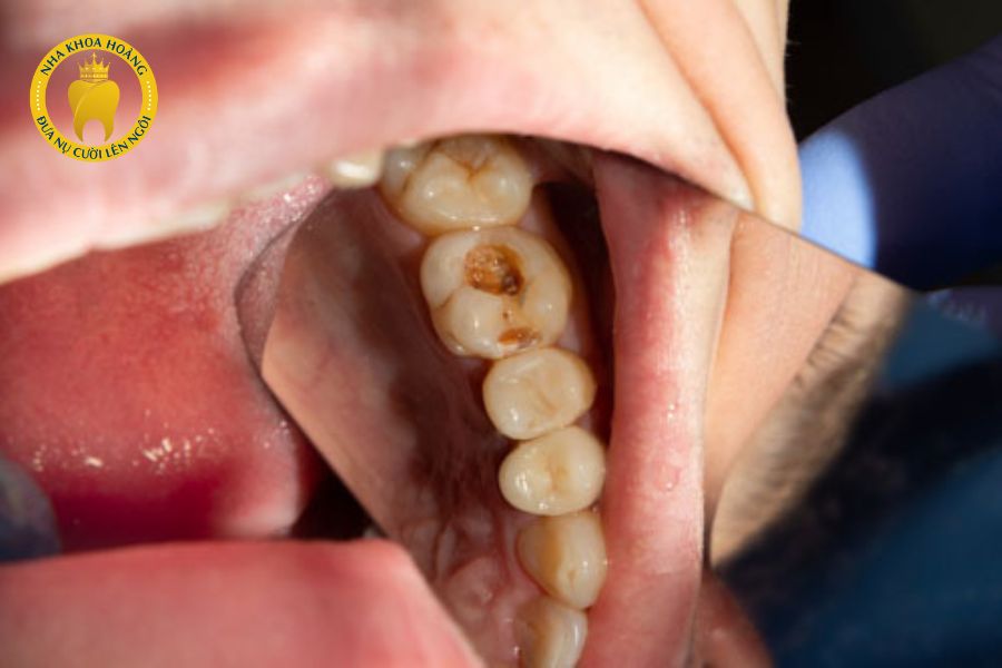 Các mức độ sâu răng và cách khắc phục.
