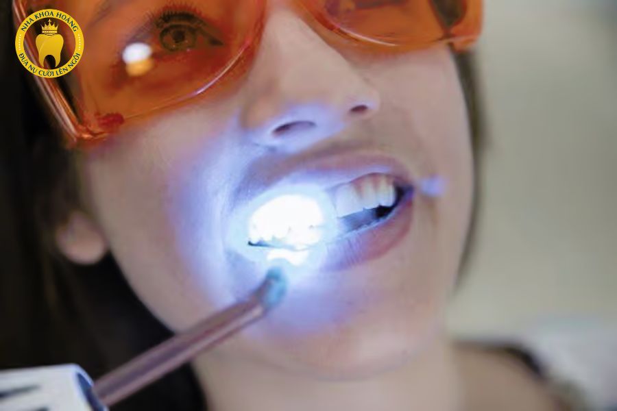 Có nên tẩy trắng răng thường xuyên không?