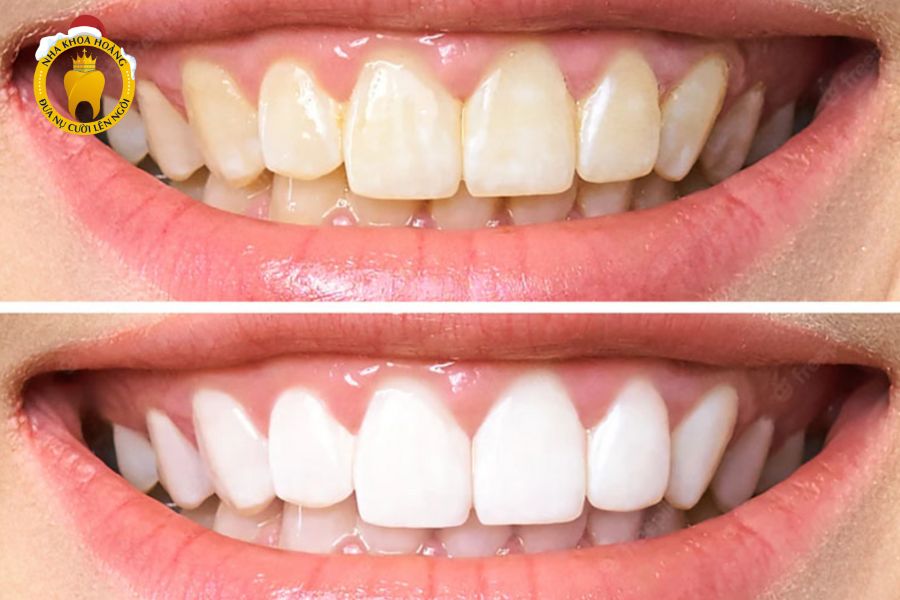 Nên làm trắng răng tại nha khoa hay tại nhà?