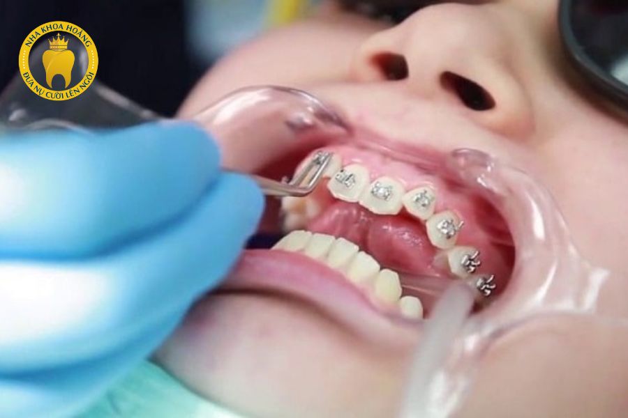 Nguyên nhân và cách khắc phục răng thưa.